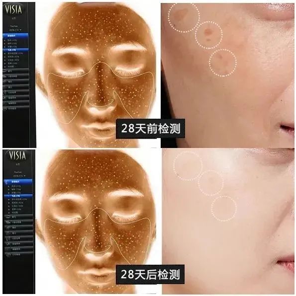 花了3万做激光,才彻底懂了:医生为什么劝你别去斑