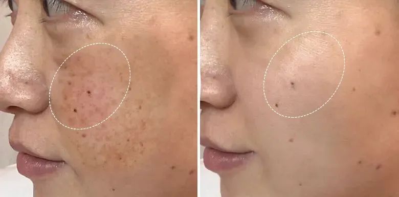 花了3万做激光,才彻底懂了:医生为什么劝你别去斑