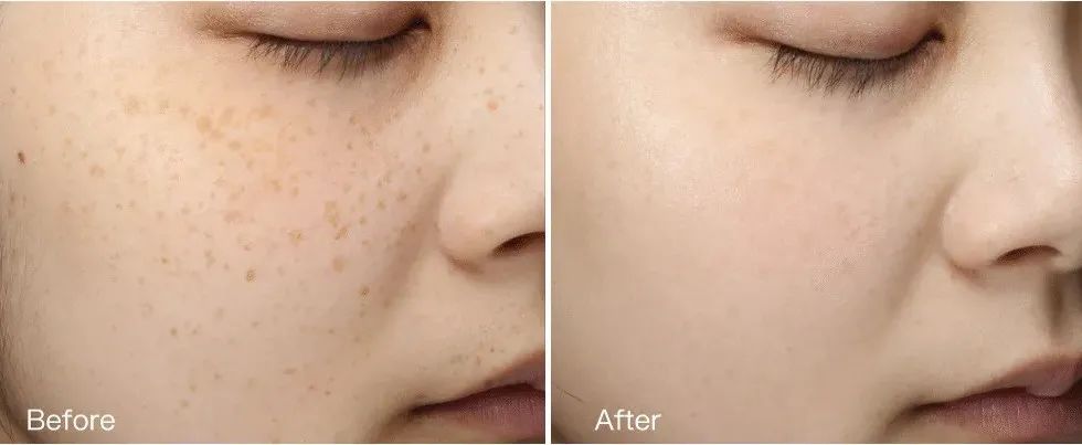 花了3万做激光,才彻底懂了:医生为什么劝你别去斑