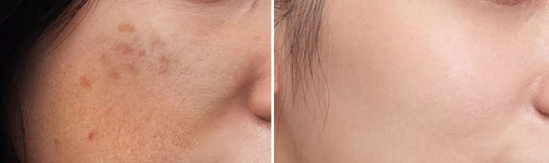 花了3万做激光，才彻底懂了：医生为什么劝你别去斑