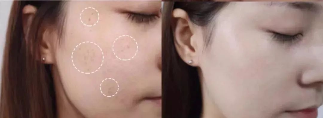 花了3万做激光,才彻底懂了:医生为什么劝你别去斑