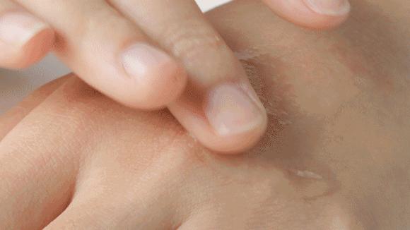 花了3万做激光,才彻底懂了:医生为什么劝你别去斑