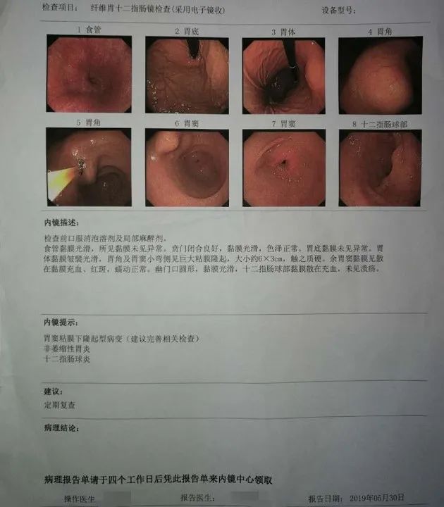 第一次胃镜病理查出癌第二次没有,做胃镜发现有肿瘤能直接做掉吗