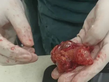 第一次胃镜病理查出癌第二次没有,做胃镜发现有肿瘤能直接做掉吗