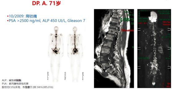 魏强、TOMBAL教授:恩扎卢胺临床数据与实践前沿