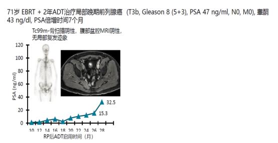 魏强、TOMBAL教授:恩扎卢胺临床数据与实践前沿