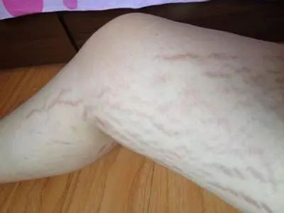 为什么体重下降反而脸变圆了,突然脸圆了一圈体重降了