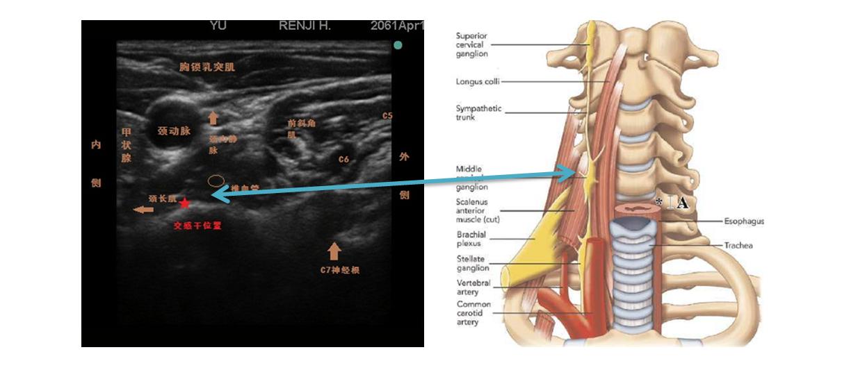 颈部肩部带状疱疹性神经痛,颈部带状疱疹治疗抹什么药