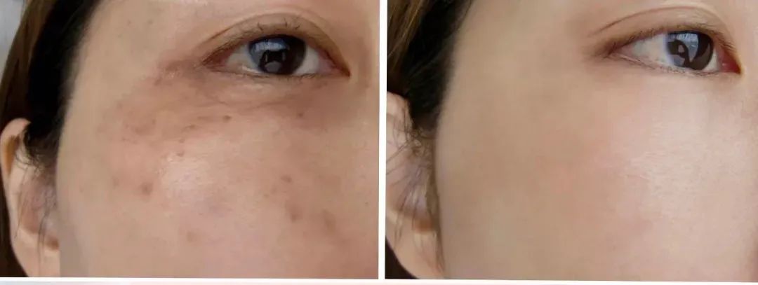 花了3万做激光，才彻底懂了：医生为什么劝你别去斑