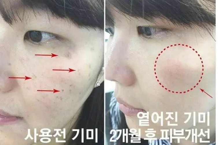 花了3万做激光，才彻底懂了：医生为什么劝你别去斑