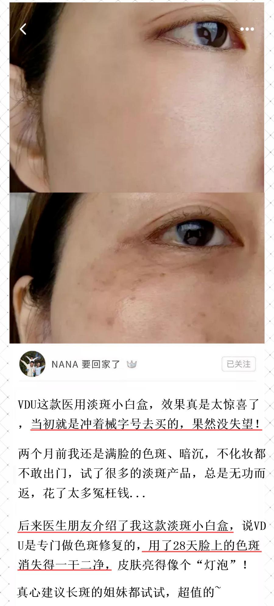 花了3万做激光，才彻底懂了：医生为什么劝你别去斑