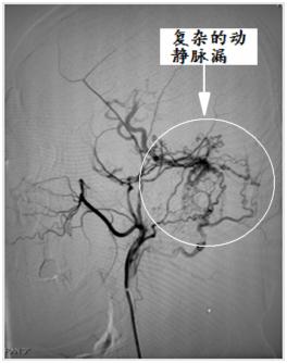硬脑膜动静脉瘘介入栓塞后的治疗,宣武医院硬脑膜动静脉瘘的治疗