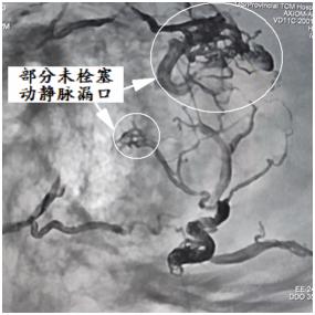 硬脑膜动静脉瘘介入栓塞后的治疗,宣武医院硬脑膜动静脉瘘的治疗