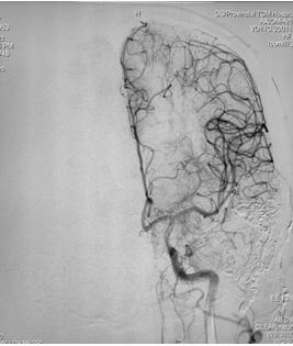 硬脑膜动静脉瘘介入栓塞后的治疗,宣武医院硬脑膜动静脉瘘的治疗