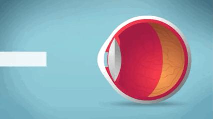 五岁半孩子眼睛散光需要干预吗,小孩眼睛散光跟家里灯光有关系吗