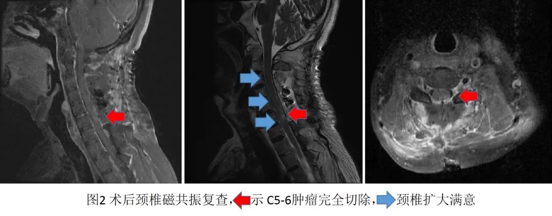 当强直性脊柱炎遇上肺结节,当强直遇上肺结核