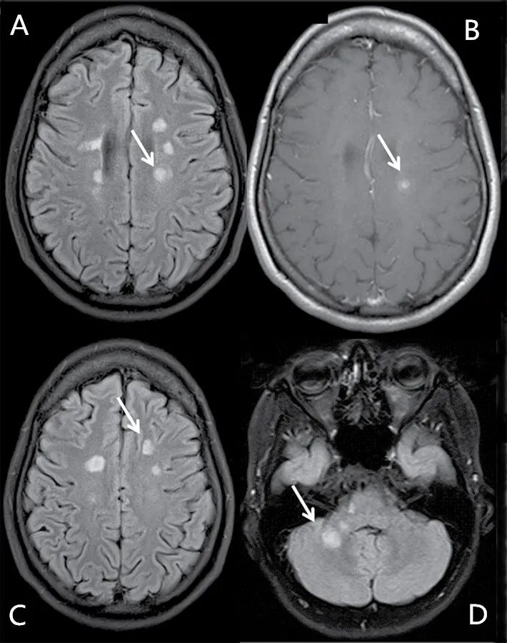 最新多发性硬化诊断标准的解读,多发性硬化患者必练动作