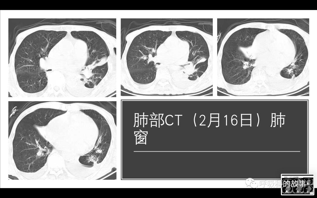 痰液培养阳性是否一定要用抗菌素?——为什么临床微生物学思维很重要(2)
