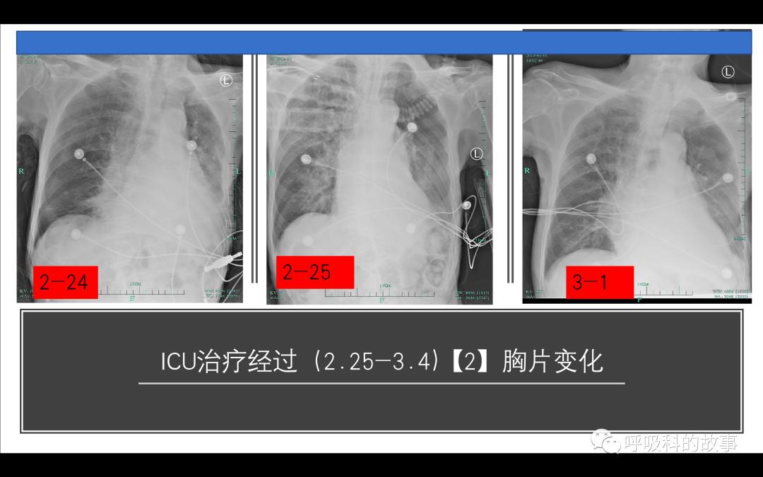 痰液培养阳性是否一定要用抗菌素?——为什么临床微生物学思维很重要(2)
