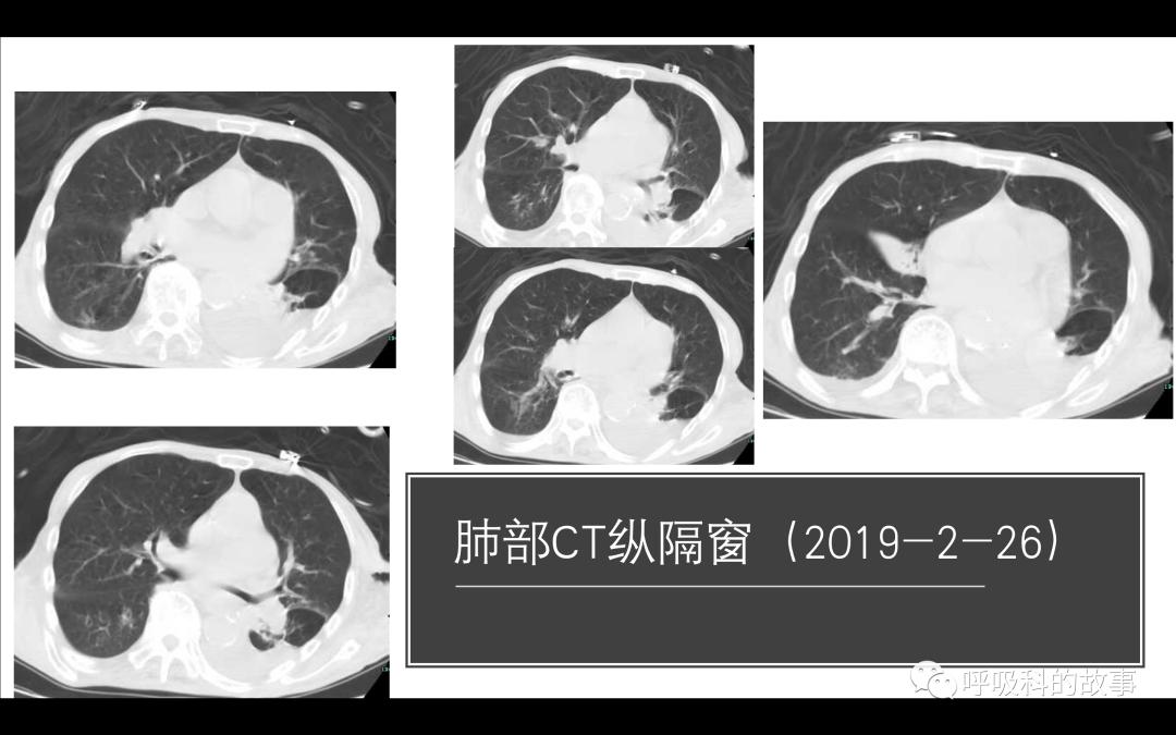 痰液培养阳性是否一定要用抗菌素?——为什么临床微生物学思维很重要(2)