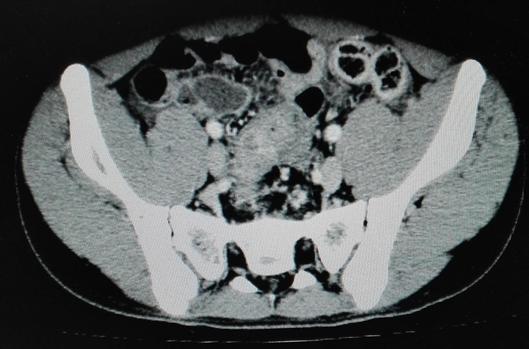 炎性肌纤维母细胞瘤最佳治疗方案,炎性肌纤维母细胞瘤成功案例