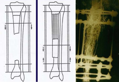 糖尿病足中医帮你消除截肢危险,警惕来自糖尿病足的截肢警告
