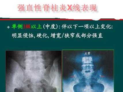 54岁得强直性脊柱炎怎么治,50多岁男性还有强直性脊柱炎吗