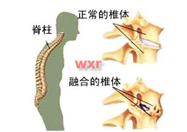 54岁得强直性脊柱炎怎么治,50多岁男性还有强直性脊柱炎吗