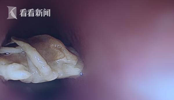 女子吞了一整只螃蟹,女子吃螃蟹被螃蟹腿吸住