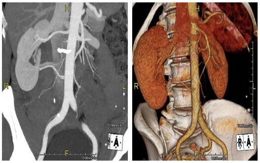 目前治愈肾癌的最好方法,早期肾癌的最新治疗方法