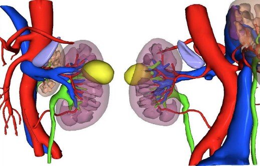 目前治愈肾癌的最好方法,早期肾癌的最新治疗方法