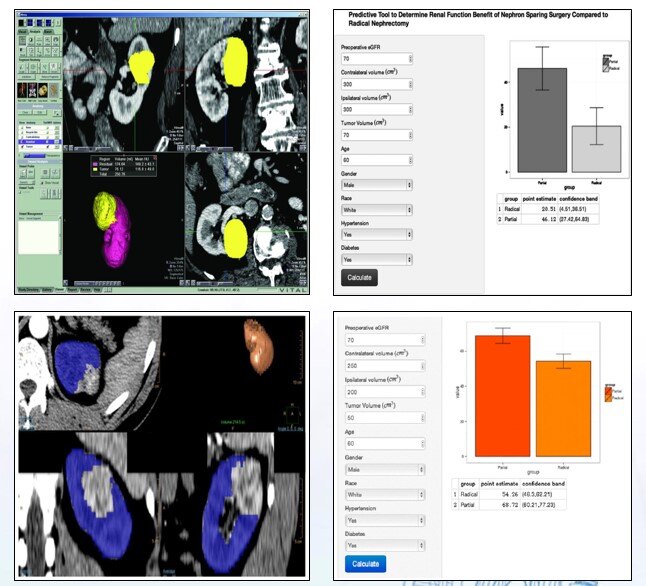目前治愈肾癌的最好方法,早期肾癌的最新治疗方法