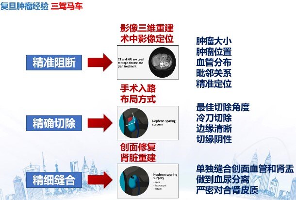 目前治愈肾癌的最好方法,早期肾癌的最新治疗方法