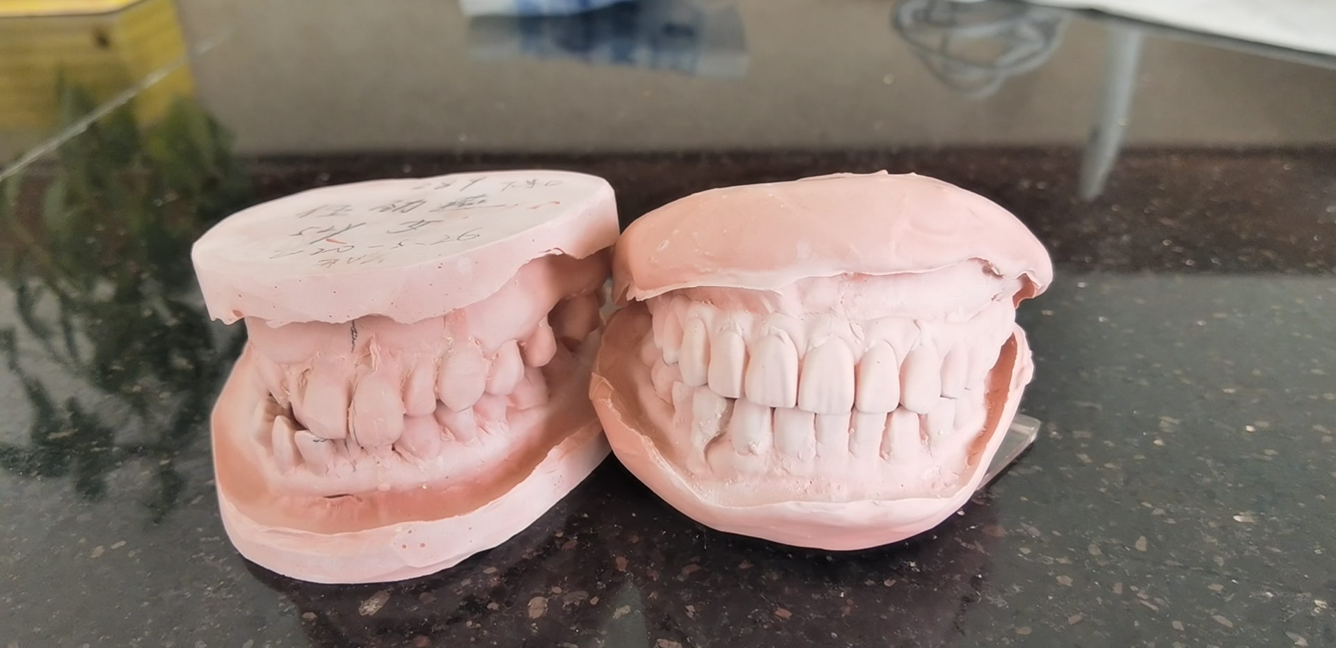 半岛叨叨丨种植牙动辄上万,一颗假牙成本才百元?