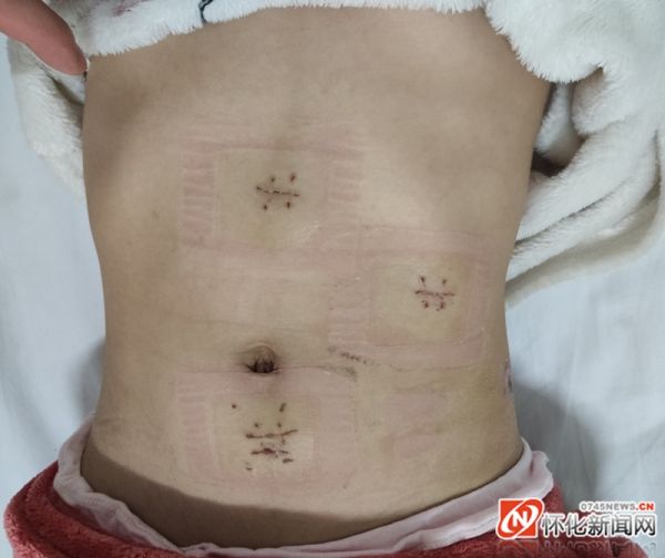 女子摔伤一周后发现脾破裂险丧命,七岁女孩摔倒致脾破裂