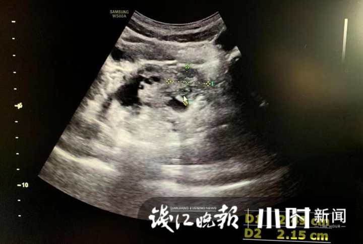 9岁小女孩腹痛难忍,9岁孩子腹痛警惕四种病