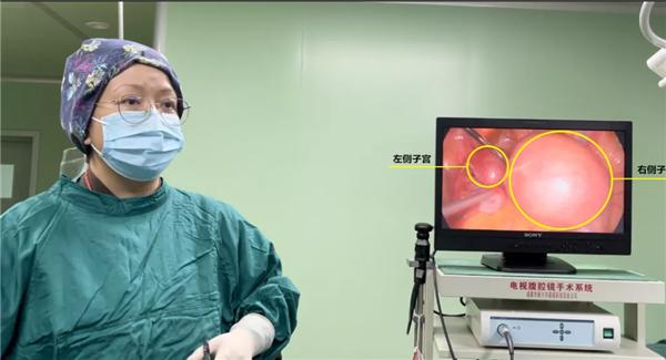 盆腔巨大包块手术风险大吗,盆腔长了巨大包块会不会死