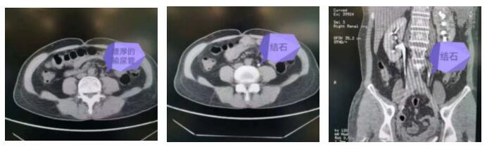 结石腰积水怎么治疗,结石梗阻肾积水怎么办