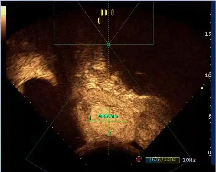 凶险的胎盘植入，轻松解决！市妇保院海扶专科成功治愈多位胎盘植入患者