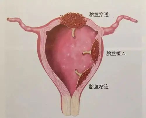 凶险的胎盘植入，轻松解决！市妇保院海扶专科成功治愈多位胎盘植入患者