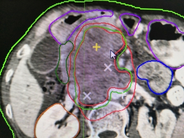 男孩身患巨型肿瘤,伽玛刀治疗大于3公分的肿瘤