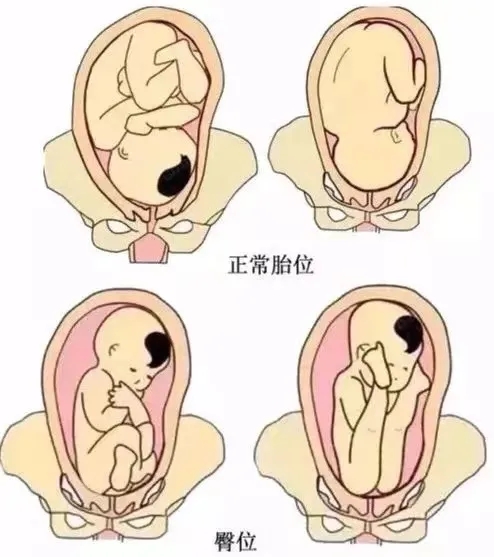 臀位外倒转术，助力臀位孕妈成功顺产