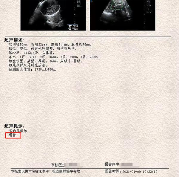 臀位外倒转术，助力臀位孕妈成功顺产