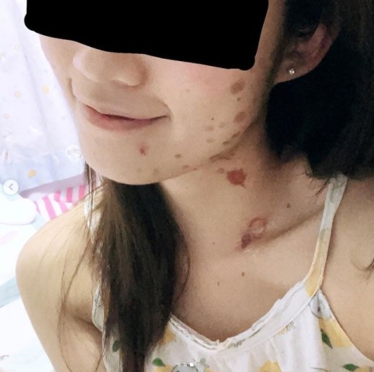 女星吃香肠被烧伤,女星炸香肠二级烧伤