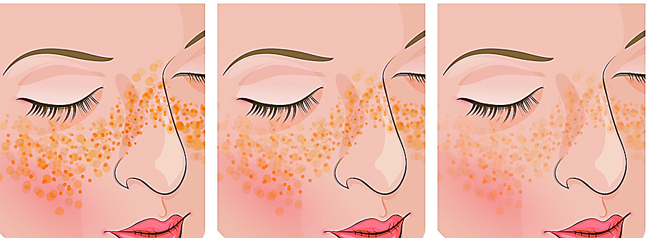 脸上有老年斑痣雀斑怎么办,脸上雀斑老年斑怎么去除