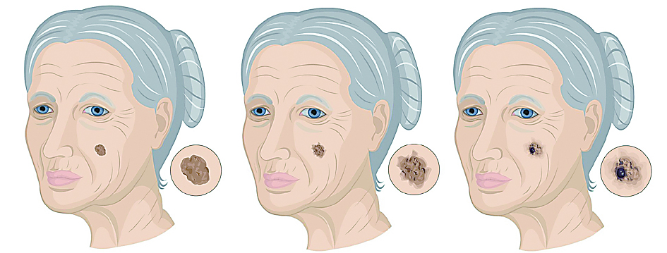 脸上有老年斑痣雀斑怎么办,脸上雀斑老年斑怎么去除