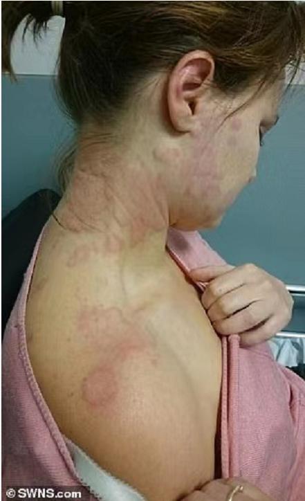 荨麻疹一精神紧张就浑身刺痛,过敏荨麻疹真是苦不堪言