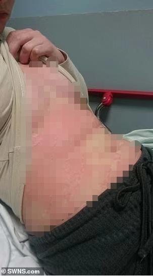 荨麻疹一精神紧张就浑身刺痛,过敏荨麻疹真是苦不堪言