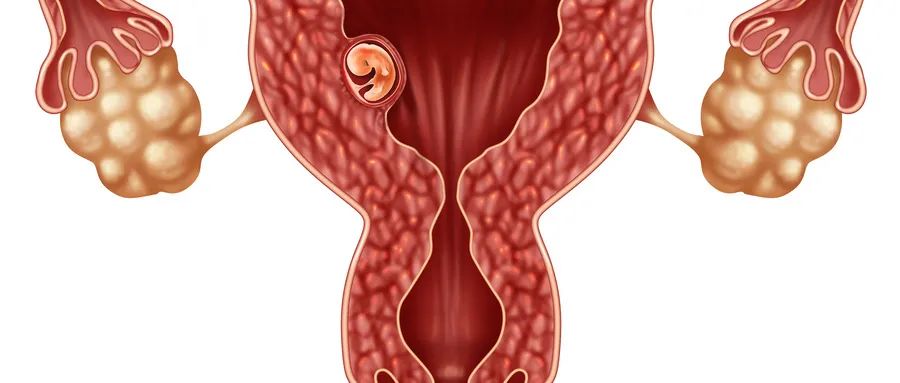 广州子宫疤痕憩室如何修复,瘢痕憩室引起妇科炎症怎么办