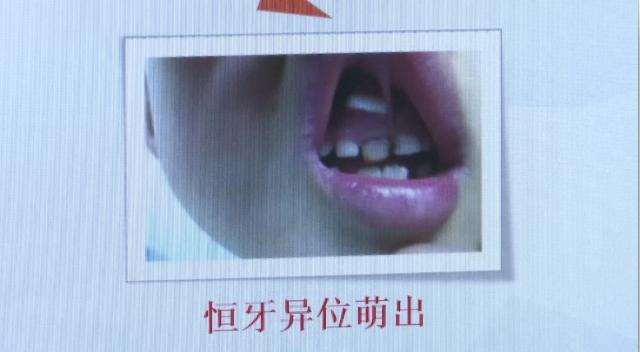 幼儿乳牙蛀牙,乳牙有蛀牙要治疗吗